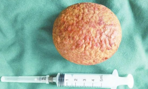 九江：男子膀胱内取出1.6斤重结石